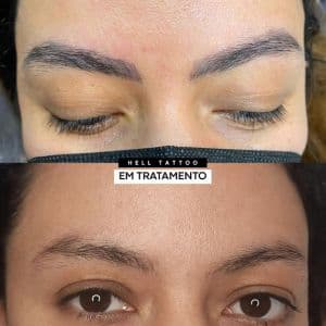Remoção de micropigmentação