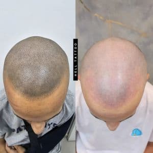 Procedimento de despigmentação