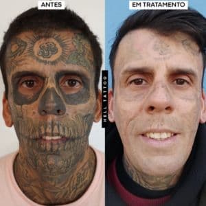 Remoção de tatuagem